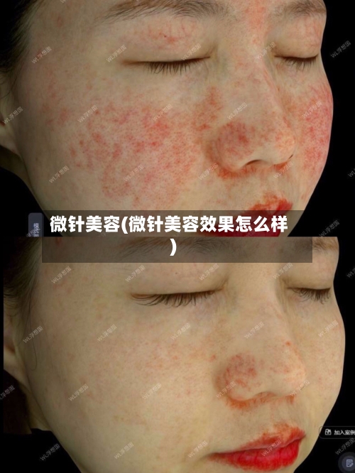 微针美容(微针美容效果怎么样)