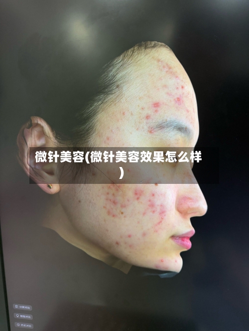 微针美容(微针美容效果怎么样)-第3张图片
